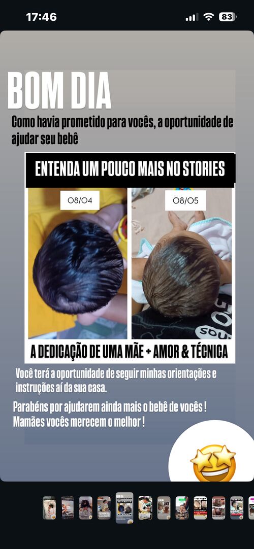 Resultado antes e depois - 1 mês de tratamento